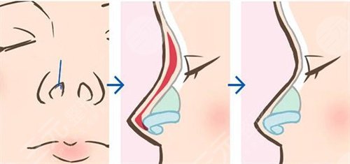 范元涛医生做鼻子怎么样|案例