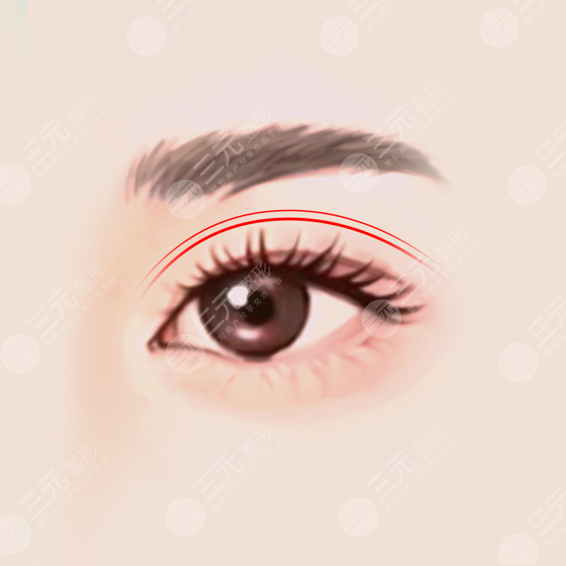 曹仁昌医生双眼皮修复案例果图分享：术前