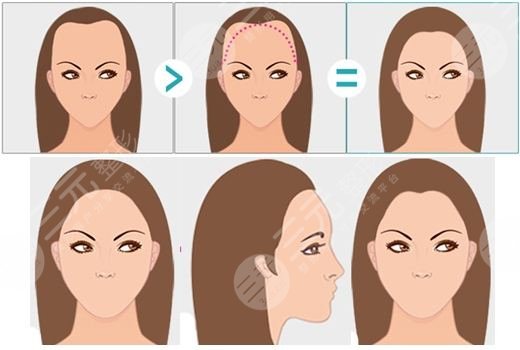 杭州时光种植发际线的案例果分享