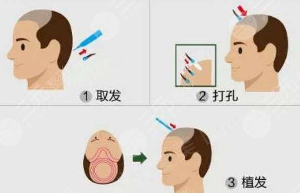 FUT种植头发技术