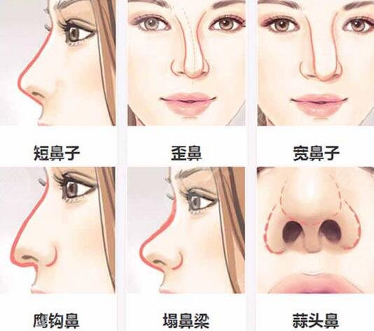 杨群申医生隆鼻案例:术前