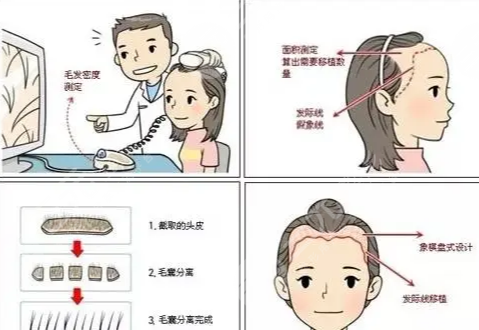 北京碧莲盛植发医院发际线种植案例