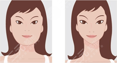 刘先超做颧骨内推术后果