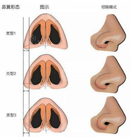 怀化天姿整形2019全新价格表详览及隆鼻整形案例分享