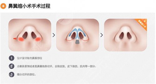 怀化天姿整形2019全新价格表详览及隆鼻整形案例分享