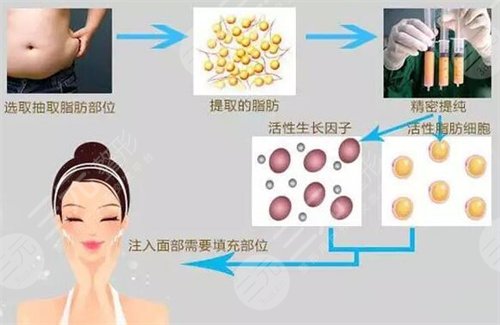2019株洲爱思特整形全新价格表曝光及自体脂肪填充案例分享