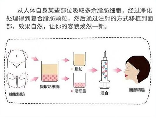 2019株洲爱思特整形全新价格表曝光及自体脂肪填充案例分享