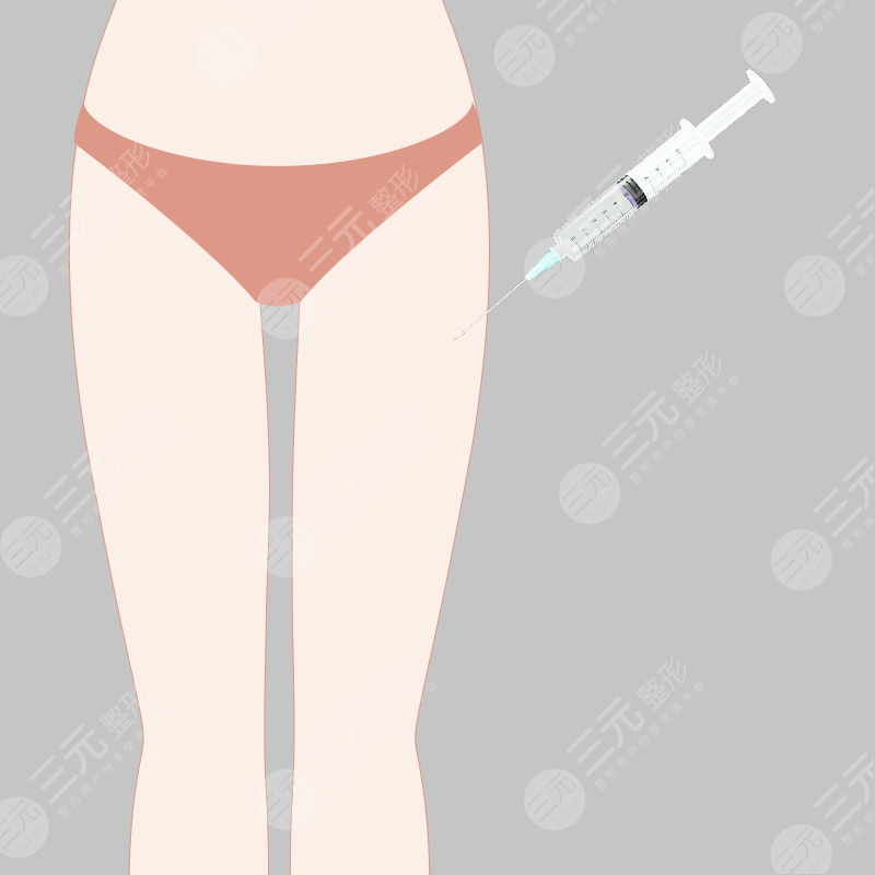 大腿吸脂案例