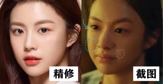 脂肪填充连明星都踩雷!要美不要当"发面馒头",这篇功课必看!