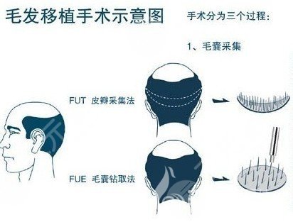 植发技术没问题吗