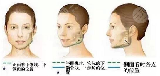 广州时光医院正颌手术术后9天