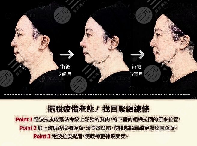 于文红面雕提升案例