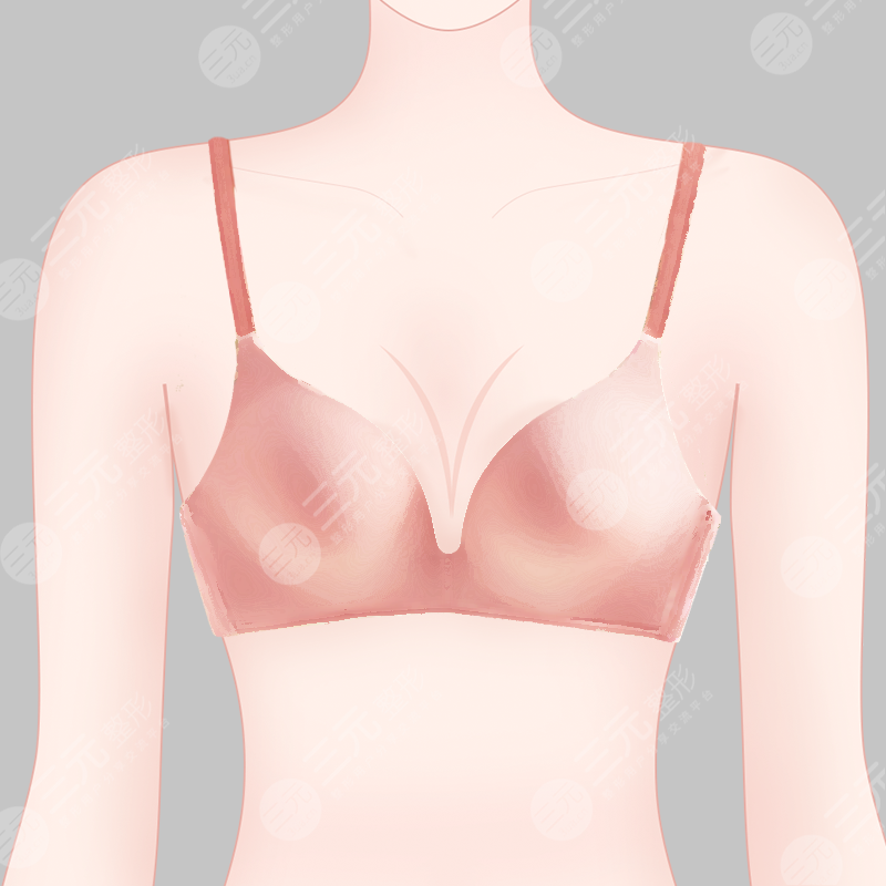 隆胸术后三个月