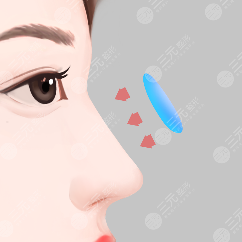 西安西京医院隆鼻整形案例