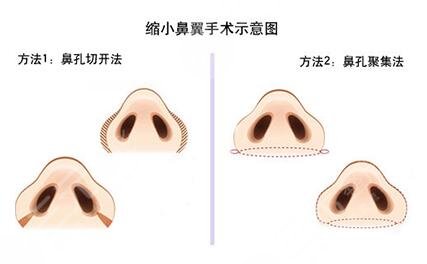 付荣峰做做鼻子案例术前