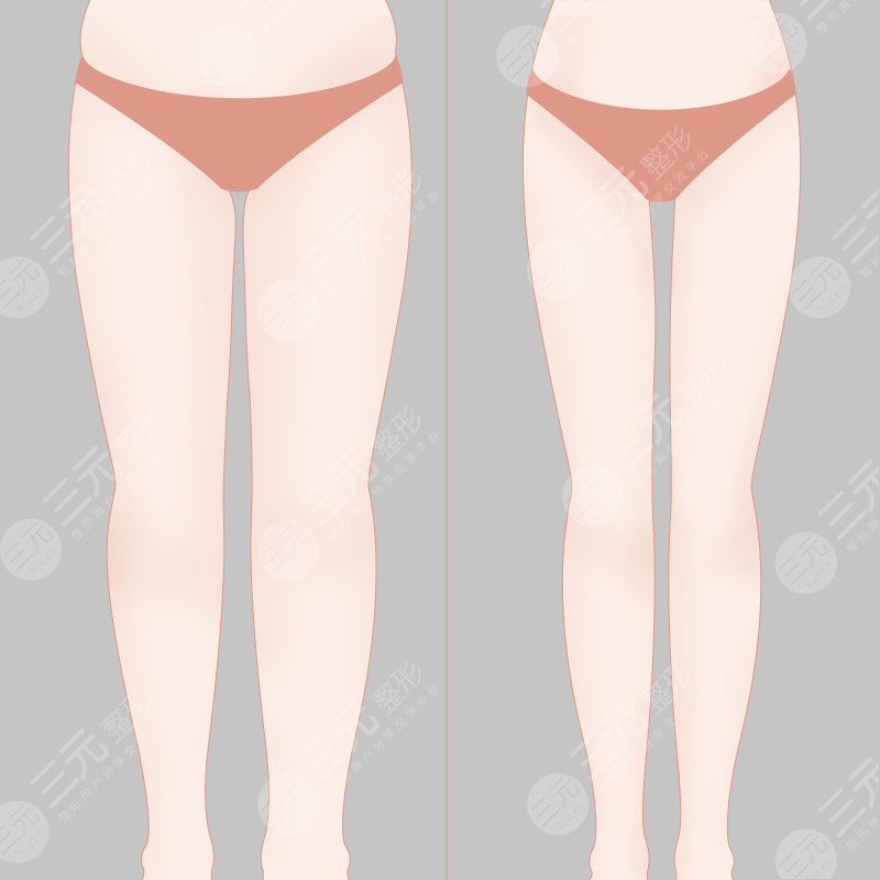 大腿吸脂案例术前图