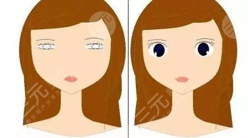 割双眼皮术前图