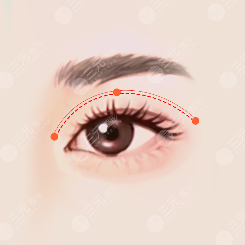 割双眼皮前后对比图