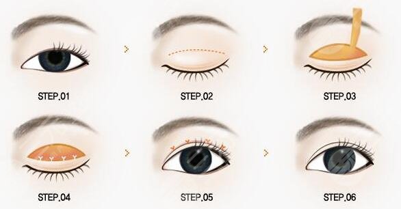 西京医院孙峰做双眼皮术后2个月