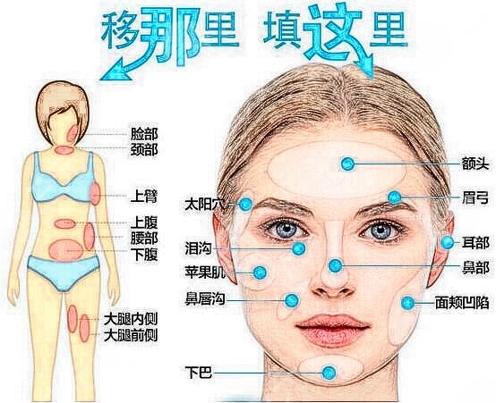 上海第九人民医院整形科脂肪面填术后