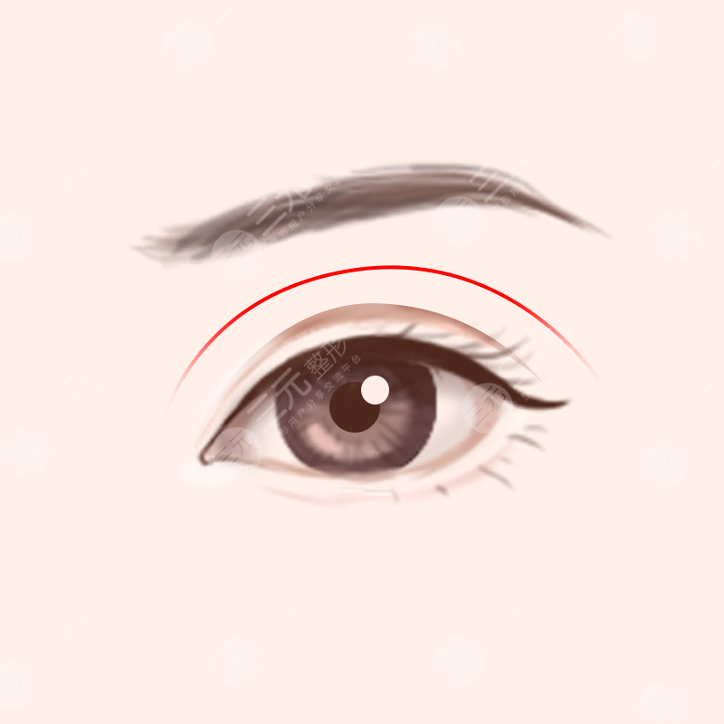 深圳于国东做双眼皮整形术前