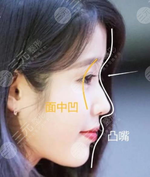 IU脸上动过哪些地方?