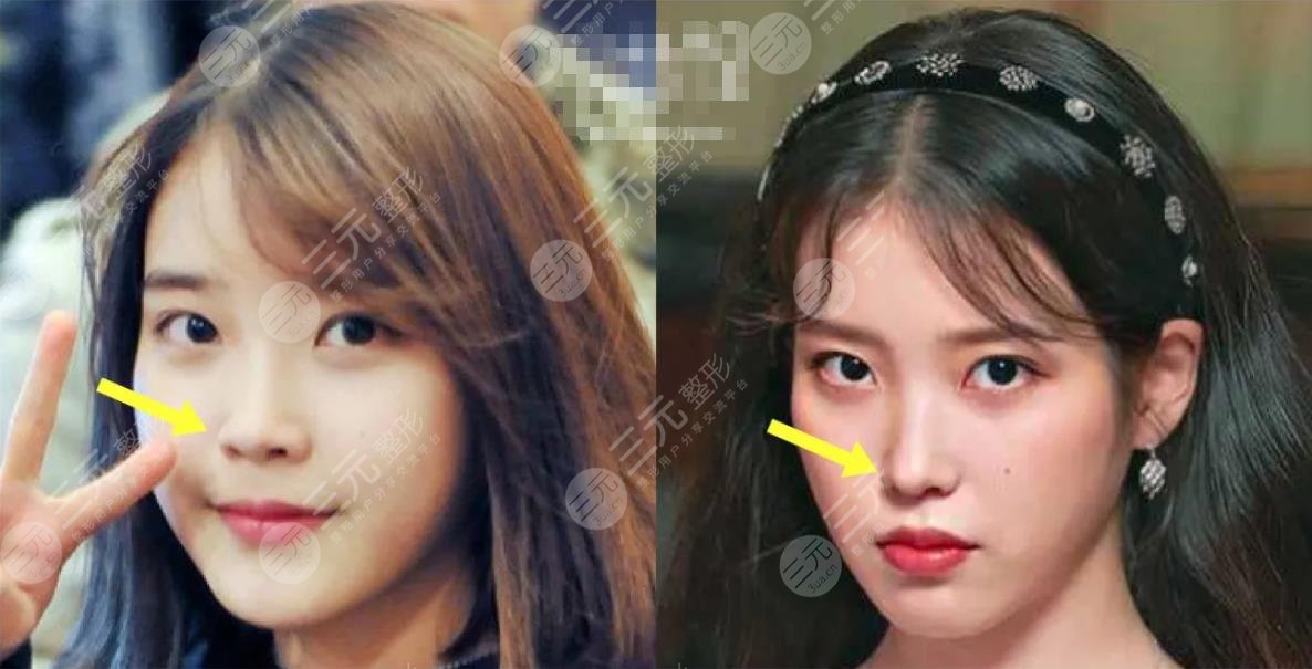 颜值分析iu李知恩变美思路不动骨微调也能变女神整容史盘点