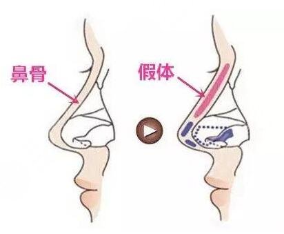 吴蒙医生隆鼻整形案例术前