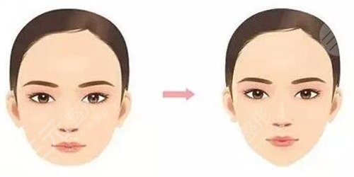 成都美极整形价格贵不贵?附垫下巴案例反馈