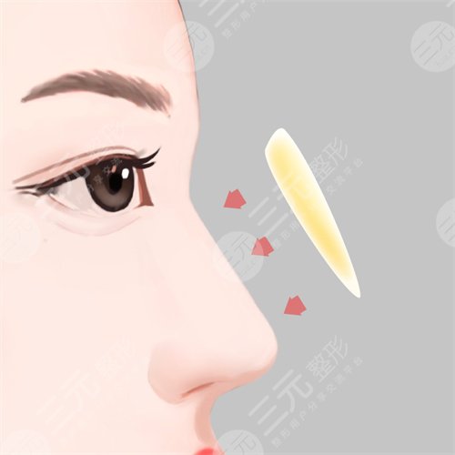 成都西区鼻部整形价格表|附隆鼻整形案例反馈