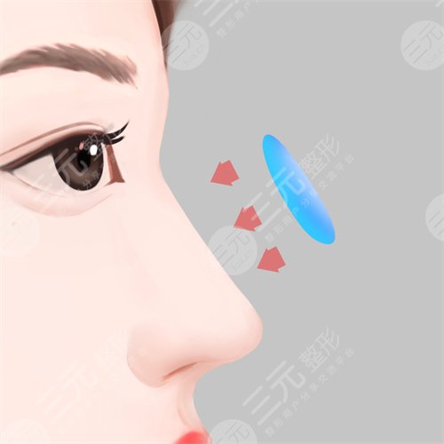 鼻部综合整形案例