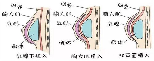 隆胸案例