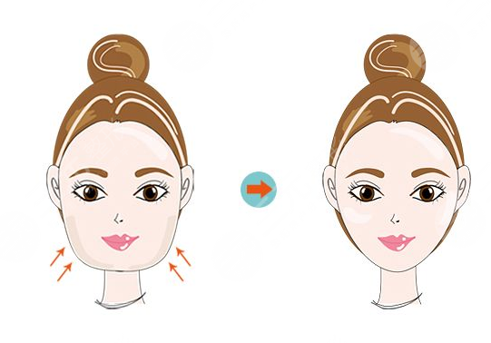  北京佰华利医美面部吸脂案例