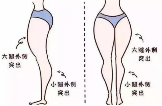 北京佰嘉利医疗美容吸脂瘦大腿案例