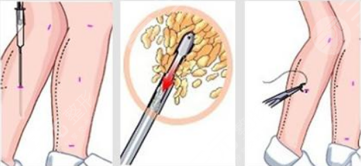北京佰嘉利医疗美容吸脂瘦大腿案例
