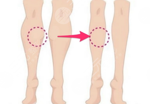 北京佰嘉利医疗美容吸脂瘦大腿案例