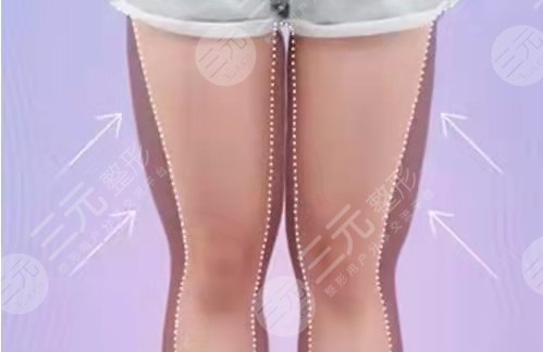 [推荐]北京八大处大腿吸脂医生哪个好？内附吸脂价格表~