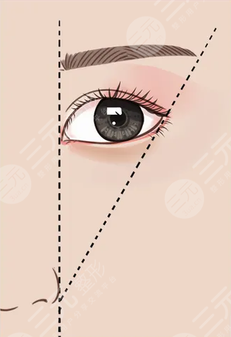 双眼皮术后果图