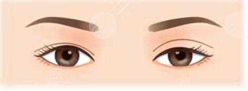 北京八大处李海东双眼皮案例分享