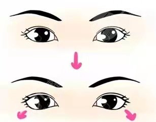 北京八大处李海东双眼皮案例分享