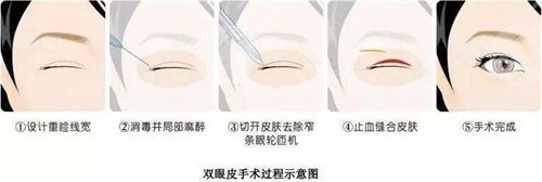 东莞东华医院整形美容科祛眼袋术前