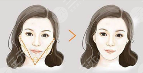 面部轮廓整形真人案例