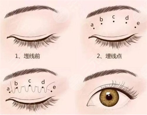 中国大一院双眼皮修复案例后4个月