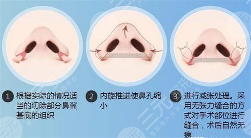 上海九医院隆鼻案例3个月果