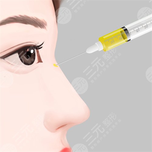 上海九院隆鼻案例前