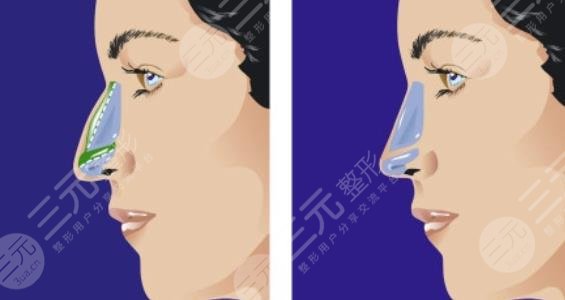 自体脂肪隆鼻