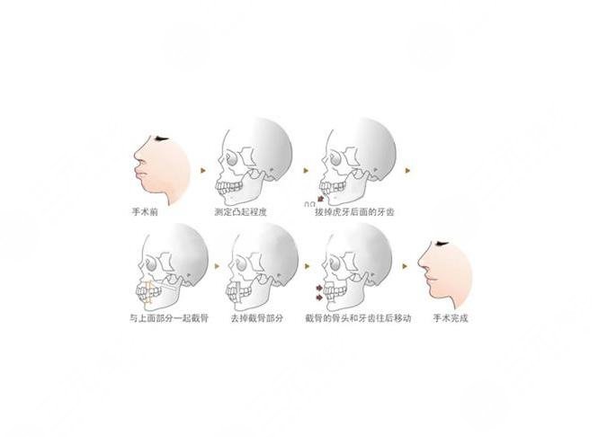 颧骨突出怎么办 磨颧骨前后对比图