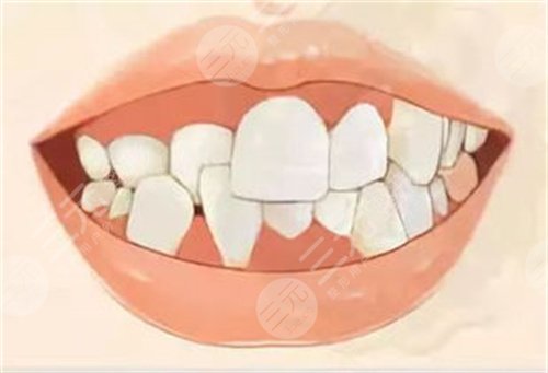 杭州口腔医院牙齿矫正案例后3个月