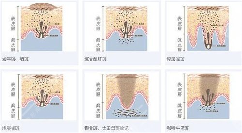 上海九院激光美容激光案例反馈前