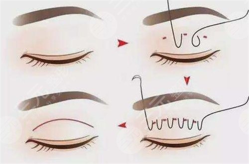 上海九院丁伟双眼皮案例前